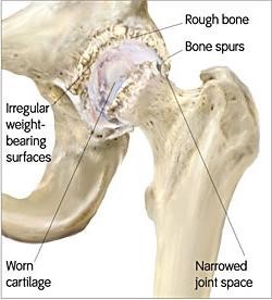 hip surgery perth