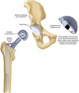 hip reconstruction
