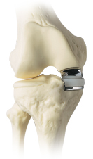 total knee replacement