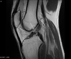 acl reconstruction