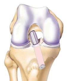 acl reconstruction