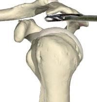 shoulder replacement