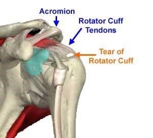 rotator cuff repair