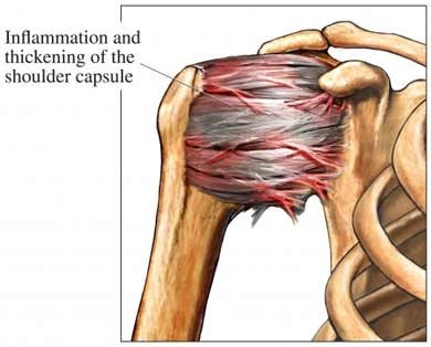 frozen shoulder