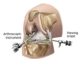 knee anthroscopy