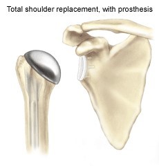 total shoulder replacement